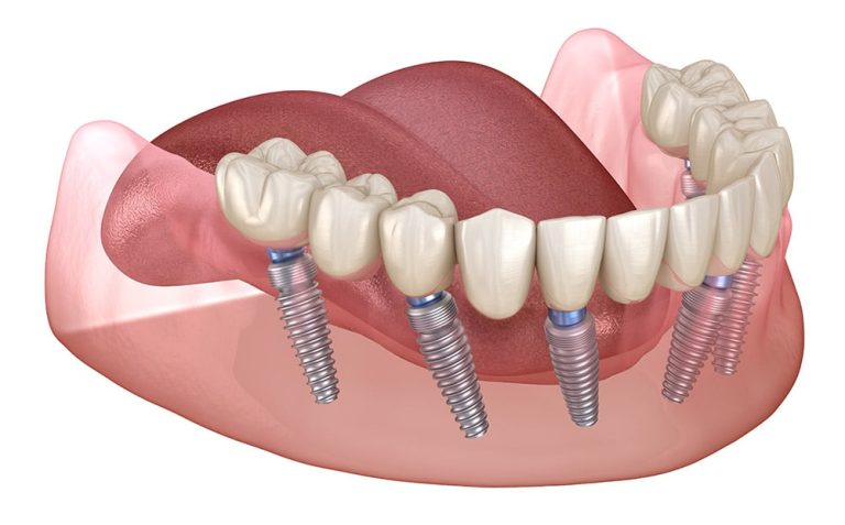 Does Medicare Cover Dental Bone Grafts?