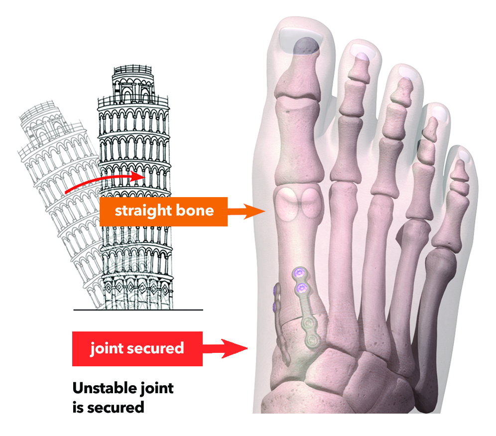 Home Page Lapiplasty NEW SFS