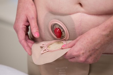 are ostomy supplies covered by medicare