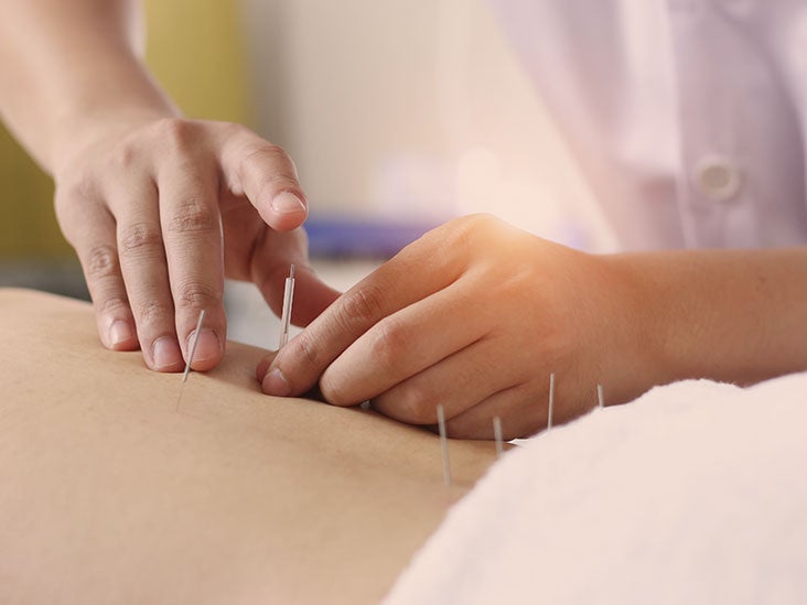 Does Medicare Cover Acupuncture for Back Pain?