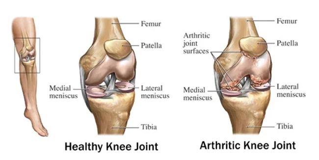 Does Medicare Cover Total Knee Replacement?