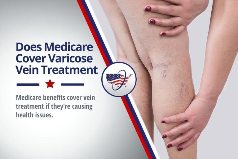 Does Medicare Cover Varicose Vein Treatment?