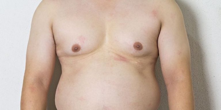 Is Gynecomastia Surgery Covered By Medicare?