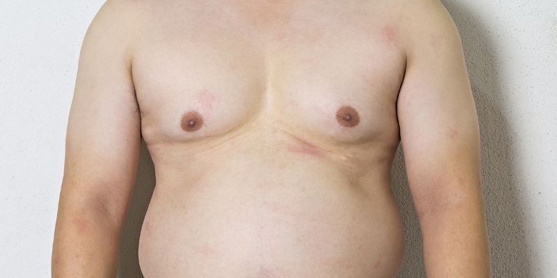 gynecomastia surgery cost australia