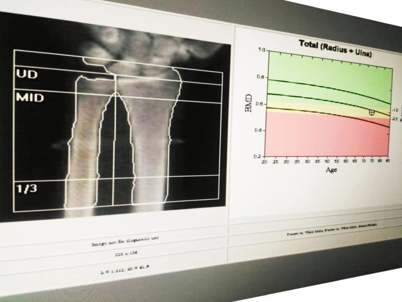 How Often Does Medicare Pay for Bone Density Test?