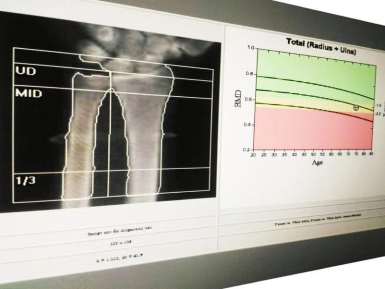 How Often Does Medicare Pay For Bone Density Test?